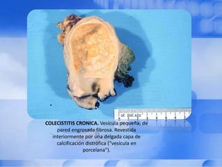 COLECISTITIS CRONICA. Vesícula pequeña, de
pared engrosada fibrosa. Revestida
interiormente por una delgada capa de
calcificación distrófica ("vesícula en
porcelana").
 