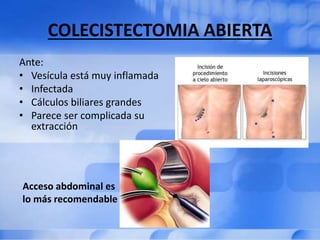 COLECISTECTOMIA ABIERTA
Ante:
• Vesícula está muy inflamada
• Infectada
• Cálculos biliares grandes
• Parece ser complicada su
extracción
Acceso abdominal es
lo más recomendable
 