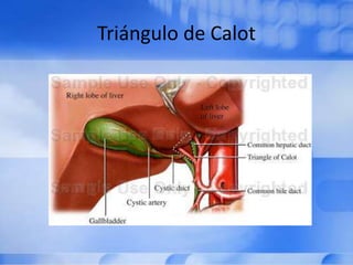Triángulo de Calot
 
