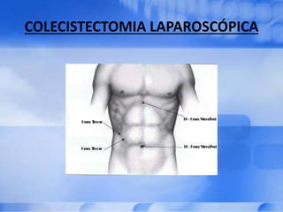 COLECISTECTOMIA LAPAROSCÓPICA
 