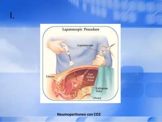 I.
Neumoperitoneo con CO2
 