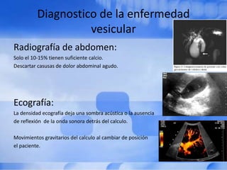 Diagnostico de la enfermedad
vesicular
Radiografía de abdomen:
Solo el 10-15% tienen suficiente calcio.
Descartar casusas de dolor abdominal agudo.
Ecografía:
La densidad ecografía deja una sombra acústica o la ausencia
de reflexión de la onda sonora detrás del calculo.
Movimientos gravitarios del calculo al cambiar de posición
el paciente.
 