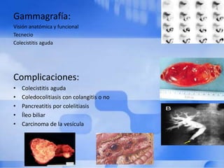 Gammagrafía:
Visión anatómica y funcional
Tecnecio
Colecistitis aguda
Complicaciones:
• Colecistitis aguda
• Coledocolitiasis con colangitis o no
• Pancreatitis por colelitiasis
• Íleo biliar
• Carcinoma de la vesícula
 