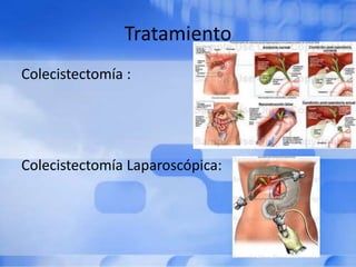 Tratamiento
Colecistectomía :
Colecistectomía Laparoscópica:
 