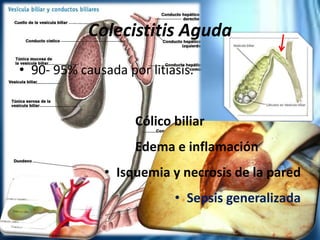 Colecistitis Aguda
• 90- 95% causada por litiasis.
Cólico biliar
Edema e inflamación
• Isquemia y necrosis de la pared
• Sepsis generalizada
 
