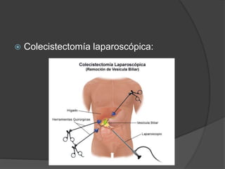  Colecistectomía laparoscópica:
 