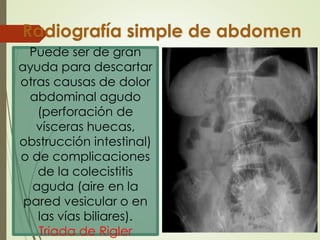 Triada Rigeler COLECISTITIS AGUDA LITIÁSICA EN CIRUGIA .pdf