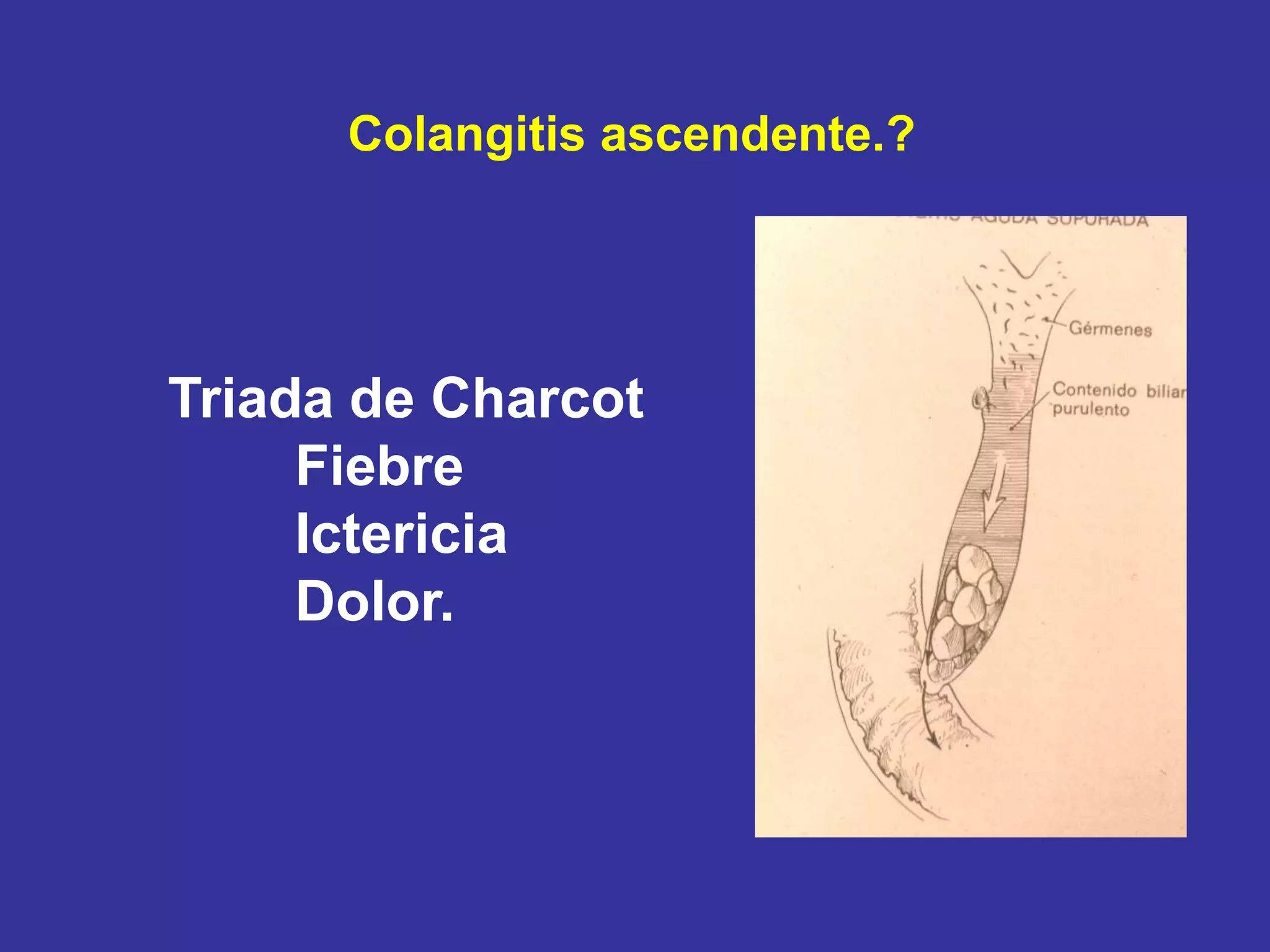 Colangitis ascendente.?




Triada de Charcot
     Fiebre
     Ictericia
     Dolor.
 