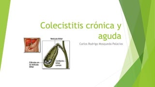 Colecistitis crónica y
aguda
Carlos Rodrigo Mosqueda Palacios
 