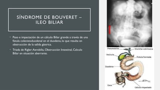 Triada Rigeler Colecistitis Litiasica y sus Complicaciones 2.pptx