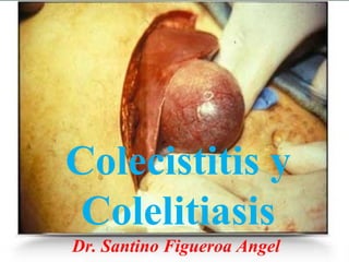 Colecistitis y
 Colelitiasis
Dr. Santino Figueroa Angel
 