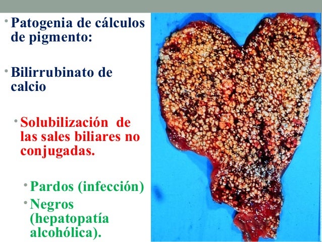 Patologia Biliar Colelitiasis Colecistitis Coledocolitiasis Images