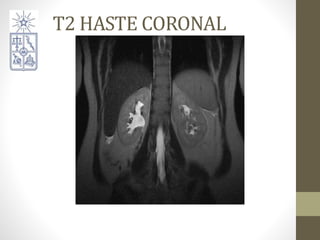 T2 HASTE CORONAL
 