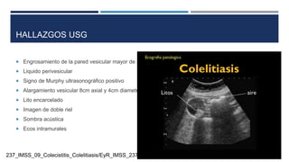 HALLAZGOS USG
 Engrosamiento de la pared vesicular mayor de 5mm
 Liquido perivesicular
 Signo de Murphy ultrasonográfico positivo
 Alargamiento vesicular 8cm axial y 4cm diametral
 Lito encarcelado
 Imagen de doble riel
 Sombra acústica
 Ecos intramurales
237_IMSS_09_Colecistitis_Colelitiasis/EyR_IMSS_237_09.pdf
 