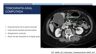 TOMOGRAFÍA AXIAL
COMPUTADA
 Engrosamiento de la pared vesicular
 Colecciones liquidas perivesiculares
 Alargamiento vesicular
 Àreas de alta densidad en el tejido graso perivesicular
237_IMSS_09_Colecistitis_Colelitiasis/EyR_IMSS_237_0
 