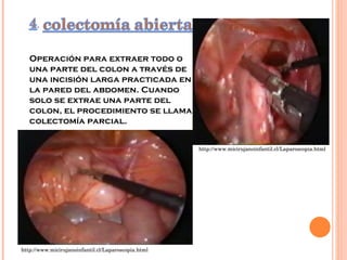 Operación para extraer todo o una parte del colon a través de una incisión larga practicada en la pared del abdomen. Cuando solo se extrae una parte del colon, el procedimiento se llama colectomía parcial. http://www.micirujanoinfantil.cl/Laparoscopia.html http://www.micirujanoinfantil.cl/Laparoscopia.html 
