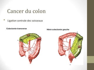 Cancer du colon
• Ligation centrale des vaisseaux
 
