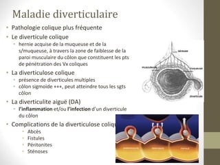 Maladie diverticulaire
• Pathologie colique plus fréquente
• Le diverticule colique
• hernie acquise de la muqueuse et de la
s/muqueuse, à travers la zone de faiblesse de la
paroi musculaire du côlon que constituent les pts
de pénétration des Vx coliques
• La diverticulose colique
• présence de diverticules multiples
• côlon sigmoïde +++, peut atteindre tous les sgts
côlon
• La diverticulite aiguë (DA)
• l’inflammation et/ou l’infection d’un diverticule
du côlon
• Complications de la diverticulose colique
• Abcès
• Fistules
• Péritonites
• Sténoses
 