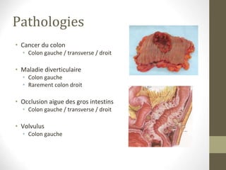 Pathologies
• Cancer du colon
• Colon gauche / transverse / droit
• Maladie diverticulaire
• Colon gauche
• Rarement colon droit
• Occlusion aigue des gros intestins
• Colon gauche / transverse / droit
• Volvulus
• Colon gauche
 