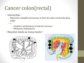 Cancer colon(rectal)
• Intervention
• Résection complète du tumeur et 5cm du colon normal de deux
côtés
• +
• Ganglions lymphatiques le long des vaisseaux
• Métastases (hépatiques)
• Résection totale au niveau locale !
 