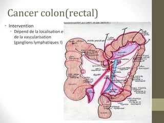 Cancer colon(rectal)
• Intervention
• Dépend de la localisation et
de la vascularisation
(ganglions lymphatiques !)
 