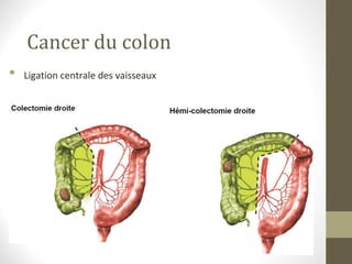 Cancer du colon
• Ligation centrale des vaisseaux
 