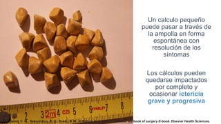 Un calculo pequeño
puede pasar a través de
la ampolla en forma
espontánea con
resolución de los
síntomas
Los cálculos pueden
quedarse impactados
por completo y
ocasionar ictericia
grave y progresiva
Townsend, C. M., Beauchamp, R. D., Evers, B. M., & Mattox, K. L. (2016). Sabiston textbook of surgery E-book. Elsevier Health Sciences.
 