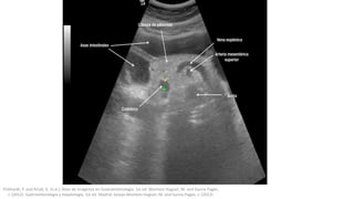 Pickhardt, P. and Arluk, G. (n.d.). Atlas de Imágenes en Gastroenterología. 1st ed. Montoro Huguet, M. and García Pagán,
J. (2012). Gastroenterología y hepatología. 1st ed. Madrid: Jarpyo.Montoro Huguet, M. and García Pagán, J. (2012).
 