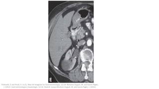 Pickhardt, P. and Arluk, G. (n.d.). Atlas de Imágenes en Gastroenterología. 1st ed. Montoro Huguet, M. and García Pagán,
J. (2012). Gastroenterología y hepatología. 1st ed. Madrid: Jarpyo.Montoro Huguet, M. and García Pagán, J. (2012).
 