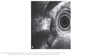 Pickhardt, P. and Arluk, G. (n.d.). Atlas de Imágenes en Gastroenterología. 1st ed. Montoro Huguet, M. and García Pagán, J. (2012).
Gastroenterología y hepatología. 1st ed. Madrid: Jarpyo.Montoro Huguet, M. and García Pagán, J. (2012).
 