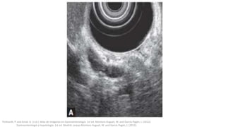 Pickhardt, P. and Arluk, G. (n.d.). Atlas de Imágenes en Gastroenterología. 1st ed. Montoro Huguet, M. and García Pagán, J. (2012).
Gastroenterología y hepatología. 1st ed. Madrid: Jarpyo.Montoro Huguet, M. and García Pagán, J. (2012).
 