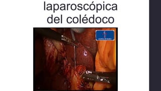 laparoscópica
del colédoco
• Al momento de la colecistectomía
• Por el conducto cístico
⚫Dilatador flexible – guía – técnica de Seldinger
 