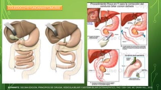 Coledoco litiasis | PPTX