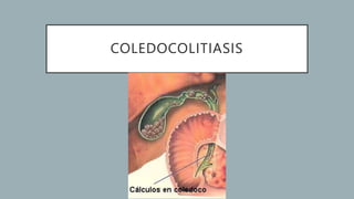 COLEDOCOLITIASIS
 