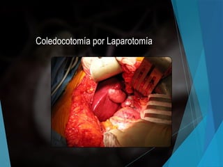 Coledocotomía por Laparotomía
 
