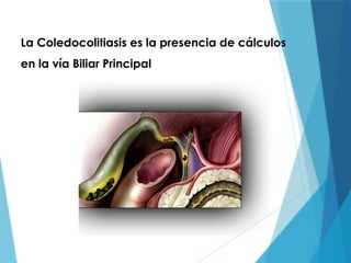 La Coledocolitiasis es la presencia de cálculos
en la vía Biliar Principal
 