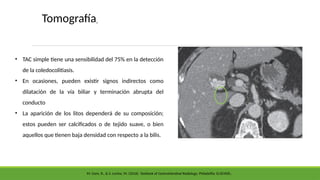 • TAC simple tiene una sensibilidad del 75% en la detección
de la coledocolitiasis.
• En ocasiones, pueden existir signos indirectos como
dilatación de la vía biliar y terminación abrupta del
conducto
• La aparición de los litos dependerá de su composición;
estos pueden ser calcificados o de tejido suave, o bien
aquellos que tienen baja densidad con respecto a la bilis.
Tomografía
M. Gore, R., & S. Levine, M. (2016). Textbook of Gastrointestinal Radiology. Philadelfia: ELSEVIER.
 
