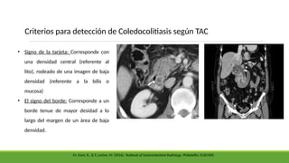 • Signo de la tarjeta: Corresponde con
una densidad central (referente al
lito), rodeado de una imagen de baja
densidad (referente a la bilis o
mucosa)
• El signo del borde: Corresponde a un
borde tenue de mayor desidad a lo
largo del margen de un área de baja
densidad.
Criterios para detección de Coledocolitiasis según TAC
M. Gore, R., & S. Levine, M. (2016). Textbook of Gastrointestinal Radiology. Philadelfia: ELSEVIER.
 