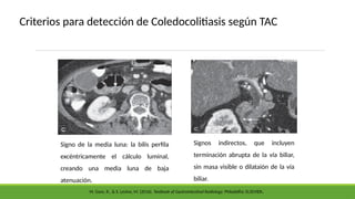 Criterios para detección de Coledocolitiasis según TAC
Signo de la media luna: la bilis perfila
excéntricamente el cálculo luminal,
creando una media luna de baja
atenuación.
Signos indirectos, que incluyen
terminación abrupta de la vía biliar,
sin masa visible o dilataión de la vía
biliar.
M. Gore, R., & S. Levine, M. (2016). Textbook of Gastrointestinal Radiology. Philadelfia: ELSEVIER.
 