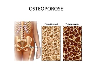 OSTEOPOROSE 