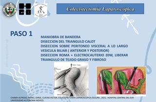 Colecistectomía Laparoscópica
PASO 1 MANIOBRA DE BANDERA
DISECCION DEL TRIANGULO CALOT
DISECCION SOBRE PERITONEO VISCERAL A LO LARGO
VESICULA BILIAR ( ANTERIOR Y POSTERIOR)
DISECCION ROMA + ELECTROCAUTERIO 20W, LIBERAR
TRIANGULO DE TEJIDO GRASO Y FIBROSO
CHAMA ALFREDO, FARREL JORGE, CUEVAS VICTOR, COLECISTECTOMIA LAPAROSCOPICA SEGURA , 2021, HOSPITAL CENTRAL DEL SUR
UNIVERSIDAD AUTONOMA MEXICO.
 
