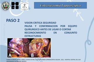 Colecistectomía Laparoscópica
PASO 2 VISION CRITICA SEGURIDAD
PAUSA Y CONFIRMACION POR EQUIPO
QUIRURGICO ANTES DE LIGAR O CORTAR
RECONOCIMIENTO EN CONJUNTO
ESTRUCTURAS
CHAMA ALFREDO, FARREL JORGE, CUEVAS VICTOR, COLECISTECTOMIA LAPAROSCOPICA SEGURA , 2021, HOSPITAL CENTRAL DEL SUR
UNIVERSIDAD AUTONOMA MEXICO.
 