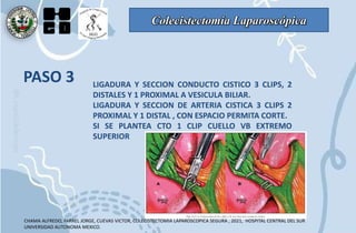 Colecistectomía Laparoscópica
PASO 3 LIGADURA Y SECCION CONDUCTO CISTICO 3 CLIPS, 2
DISTALES Y 1 PROXIMAL A VESICULA BILIAR.
LIGADURA Y SECCION DE ARTERIA CISTICA 3 CLIPS 2
PROXIMAL Y 1 DISTAL , CON ESPACIO PERMITA CORTE.
SI SE PLANTEA CTO 1 CLIP CUELLO VB EXTREMO
SUPERIOR
CHAMA ALFREDO, FARREL JORGE, CUEVAS VICTOR, COLECISTECTOMIA LAPAROSCOPICA SEGURA , 2021, HOSPITAL CENTRAL DEL SUR
UNIVERSIDAD AUTONOMA MEXICO.
 