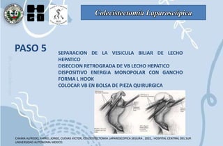 Colecistectomía Laparoscópica
PASO 5 SEPARACION DE LA VESICULA BILIAR DE LECHO
HEPATICO
DISECCION RETROGRADA DE VB LECHO HEPATICO
DISPOSITIVO ENERGIA MONOPOLAR CON GANCHO
FORMA L HOOK
COLOCAR VB EN BOLSA DE PIEZA QUIRURGICA
CHAMA ALFREDO, FARREL JORGE, CUEVAS VICTOR, COLECISTECTOMIA LAPAROSCOPICA SEGURA , 2021, HOSPITAL CENTRAL DEL SUR
UNIVERSIDAD AUTONOMA MEXICO.
 