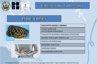Colecistectomía Laparoscópica
Dr. Rodriguez Montalvo et al. Indicaciones y Técnicas en Cirugía Laparoscópica Biliar. Cirugía Hepatobiliar. Capítulo 8. Venezuela.
INDICACIONES
COLECISTITIS AGUDA Y CRONICA
LITIASIS VESICULAR
COLICO BILIAR PERSISTENTE
COLECISTITIS ALITIASICA (DISCINESIA VESICULAR)
POLIPOS VESICULARES MAYOR 1CM
VESICULA EN PORCELANA
GANGRENA VESICULAR
SINDROME MIRIZZI
TRAUMATISMO VESICULAR
 