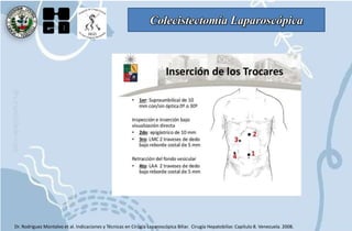 Colecistectomía Laparoscópica
Dr. Rodriguez Montalvo et al. Indicaciones y Técnicas en Cirugía Laparoscópica Biliar. Cirugía Hepatobiliar. Capítulo 8. Venezuela. 2008.
 