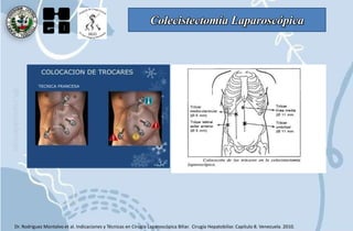 Colecistectomía Laparoscópica
Dr. Rodriguez Montalvo et al. Indicaciones y Técnicas en Cirugía Laparoscópica Biliar. Cirugía Hepatobiliar. Capítulo 8. Venezuela. 2010.
 