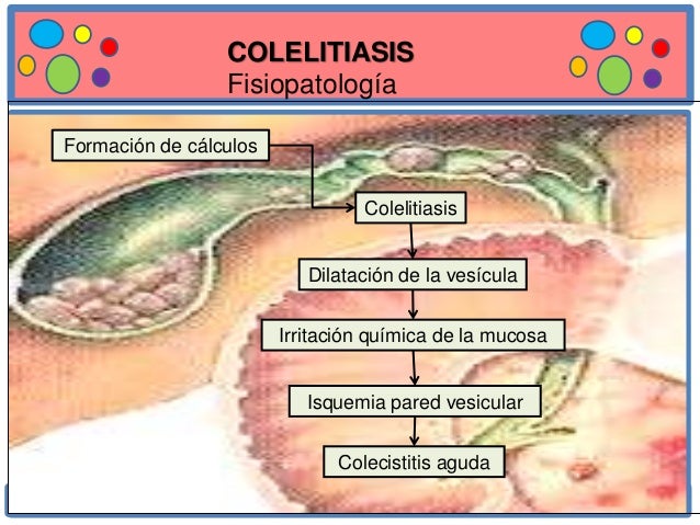Colecistitis Y Colelitiasis Download Pptx Powerpoint Images