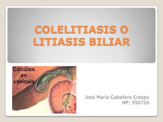 COLELITIASIS O
LITIASIS BILIAR
José María Caballero Crespo
NP: 550720
 