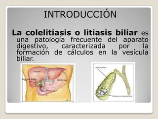 INTRODUCCIÓN
La colelitiasis o litiasis biliar es
una patología frecuente del aparato
digestivo, caracterizada por la
form...